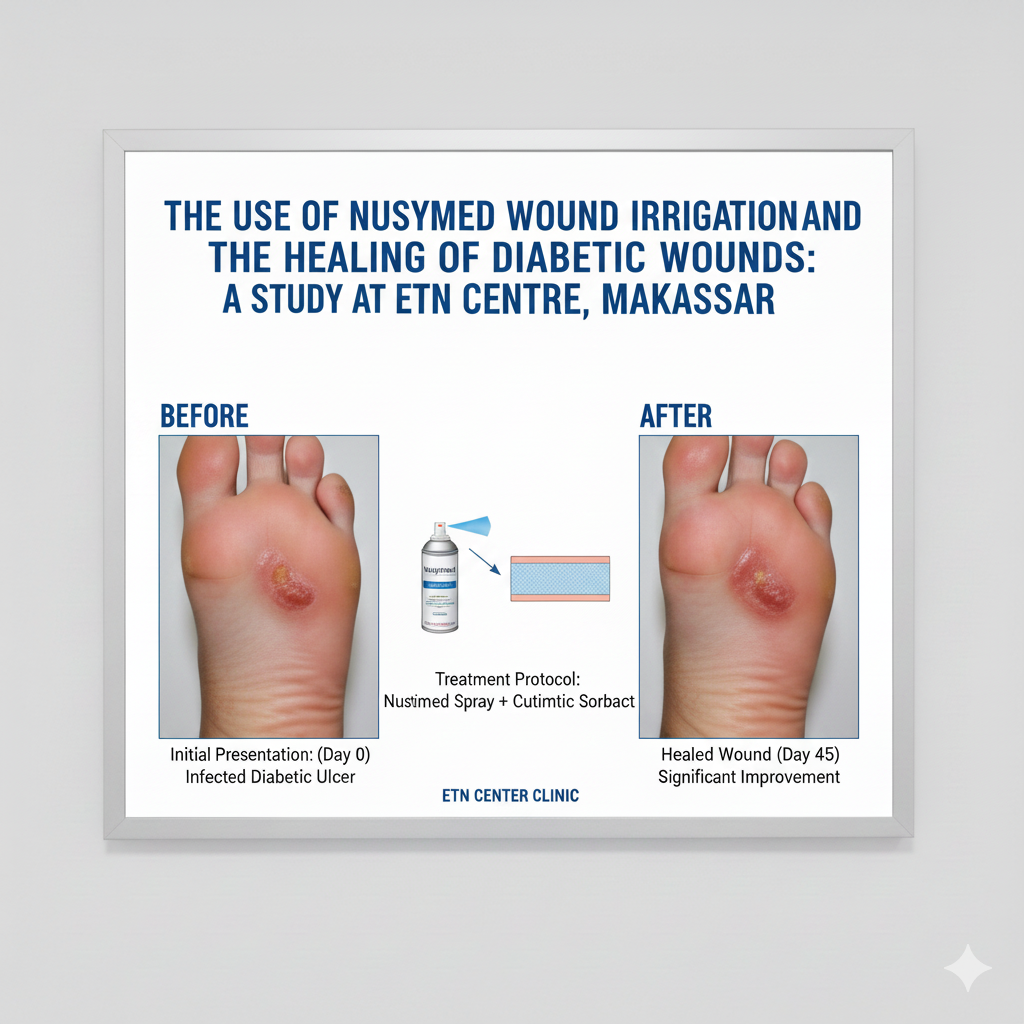 The Use of Nusymed Wound Irrigation Spray and Cutimed Sorbact in the Healing of Diabetic Wounds: A Study at ETN Centre, Makassar